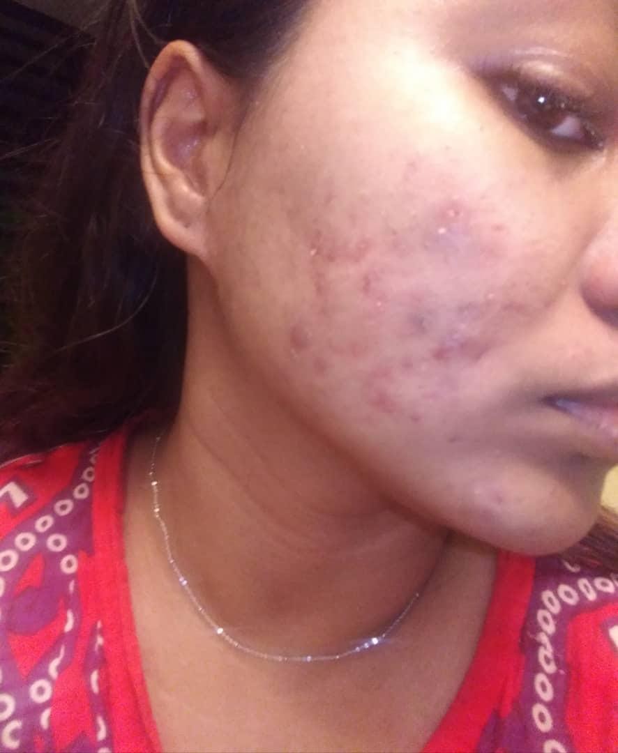 severe acne